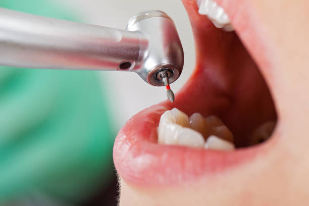 Best Urgent Tooth Repair  in Irvington, KY